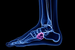 Several Reasons Why Cuboid Syndrome May Develop