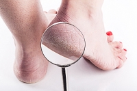 Treatment for Dry or Cracked Heels