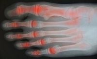 Can Walking Help Arthritis in the Feet?